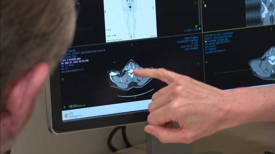 新たな免疫療法により進行性黒色腫の再発率が5%未満に低下